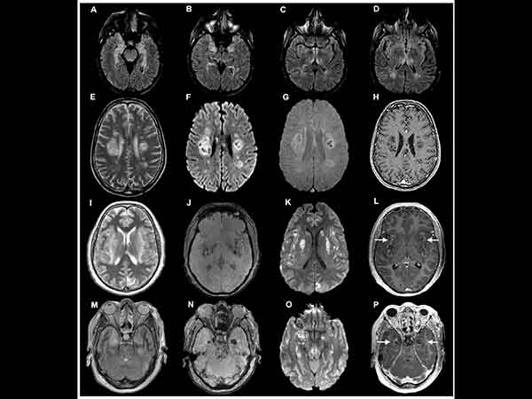 El coronavirus ataca al cerebro de este modo