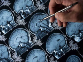 Cinco señales que te alertan del Alzheimer, según la Universidad de Cambridge