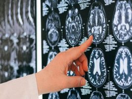 Un hallazgo desde El Calafate: investigadores locales identificaron un gen que mejora la recuperación tras un ACV