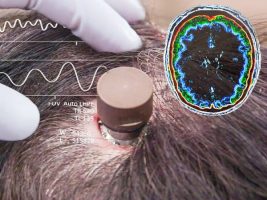 Cómo funciona el chip cerebral de Elon Musk que controla dispositivos con el pensamiento