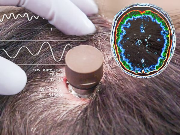 Cómo funciona el chip cerebral de Elon Musk que controla dispositivos con el pensamiento