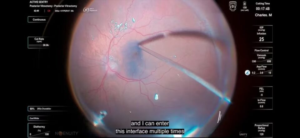 Oftalmólogos argentinos reciben una distinción internacional por una técnica innovadora en cirugía de retina